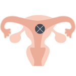 ピル作用・着床阻止