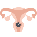 ピル作用・精子阻止