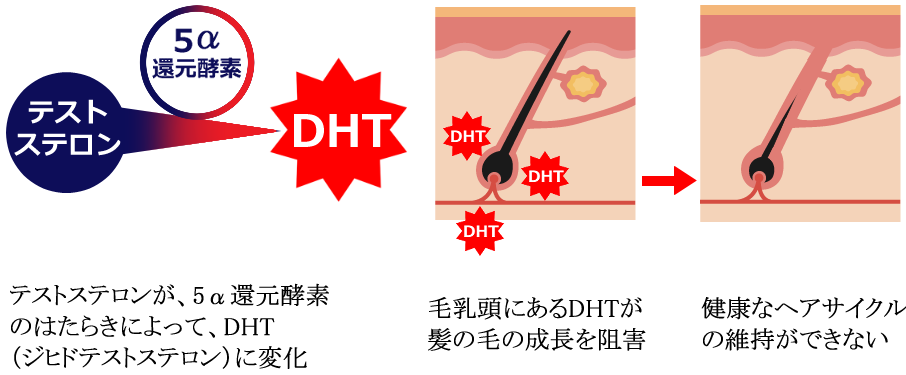 AGA発症と進行